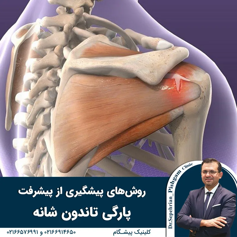 روش‌های پیشگیری از پیشرفت پارگی تاندون شانه