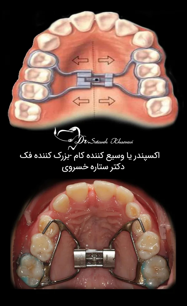 بزرگ کننده کام ،اکسپندر یا وسیع کننده کام فک چیست؟