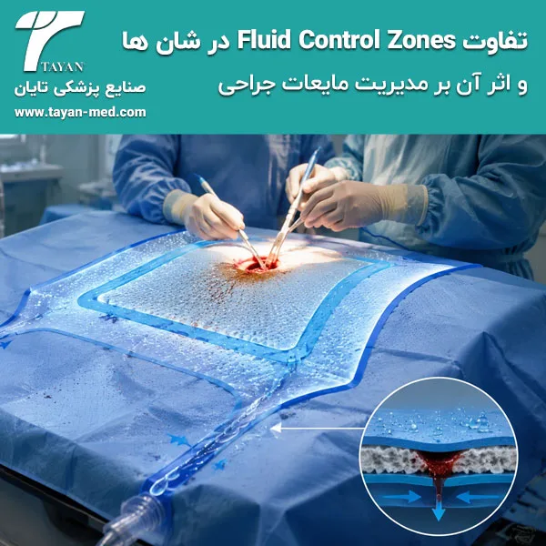تفاوت Fluid Control Zones در شان ها و اثر آن بر مدیریت مایعات جراحی