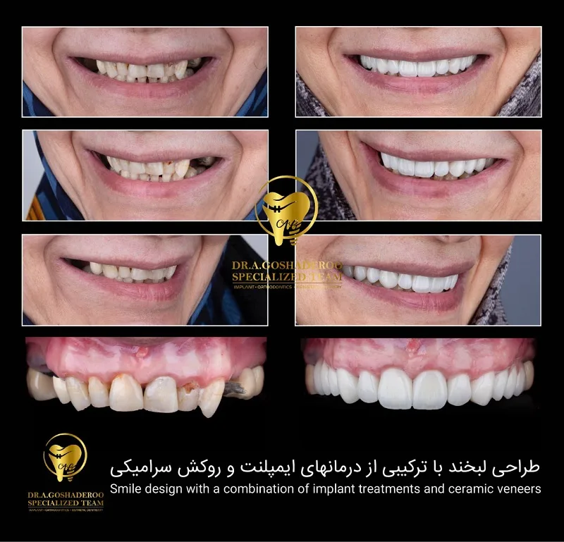 ایمپلنت فوری همزمان با کشیدن ریشه دندان چگونه است؟