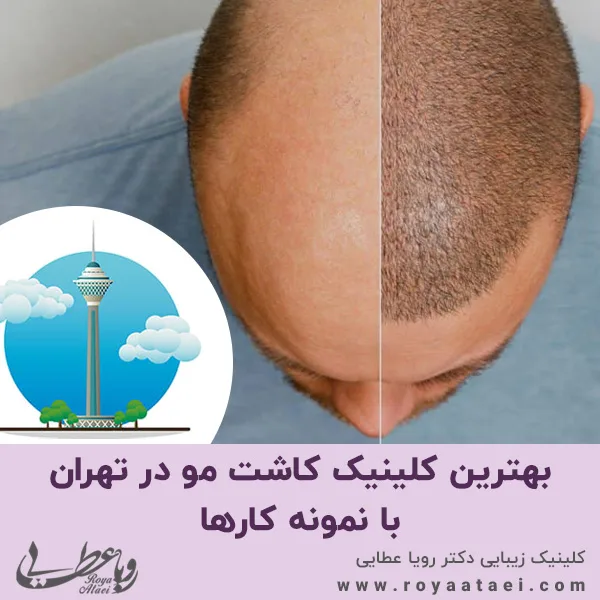 بهترین کلینیک کاشت مو در تهران با نمونه کارها