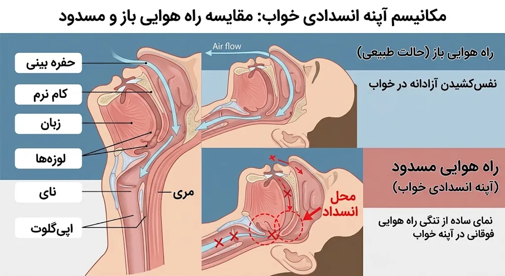 مکانیسم آپنه