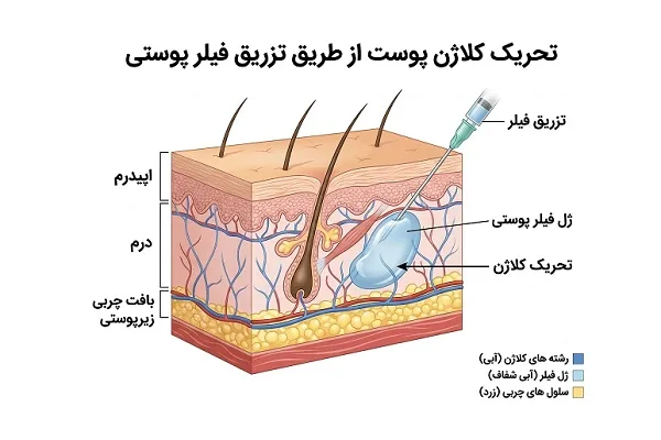 تحریک کلاژن سازی با فیلربادی