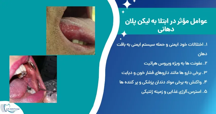 بهترین راه درمان بیماری لیکن پلان دهانی: راهنمای جامع