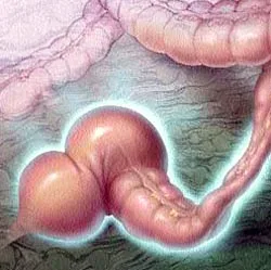 فکال ایمپکشن ( Fecal Impaction)