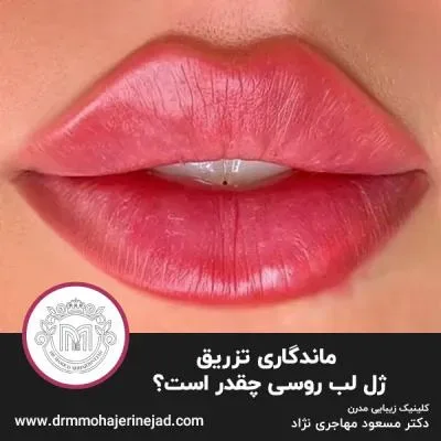 ماندگاری تزریق ژل لب روسی چقدر است؟