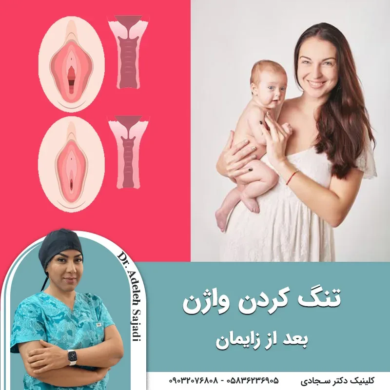 تنگ کردن واژن بعد از زایمان