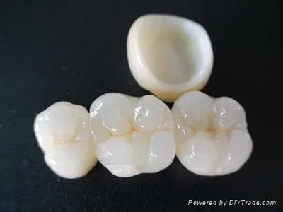 روکش تمام سرامیکی