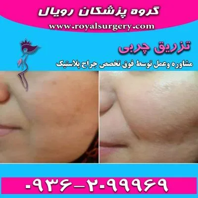 تزریق چربی در گروه پزشکان رویال