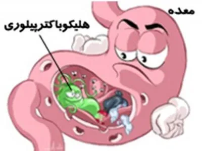 عفونت هليكو باكتر پيلوري