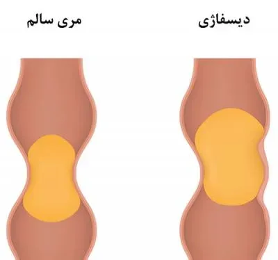 ديسفاژي