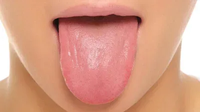 سرطان زبان، به زبان ساده