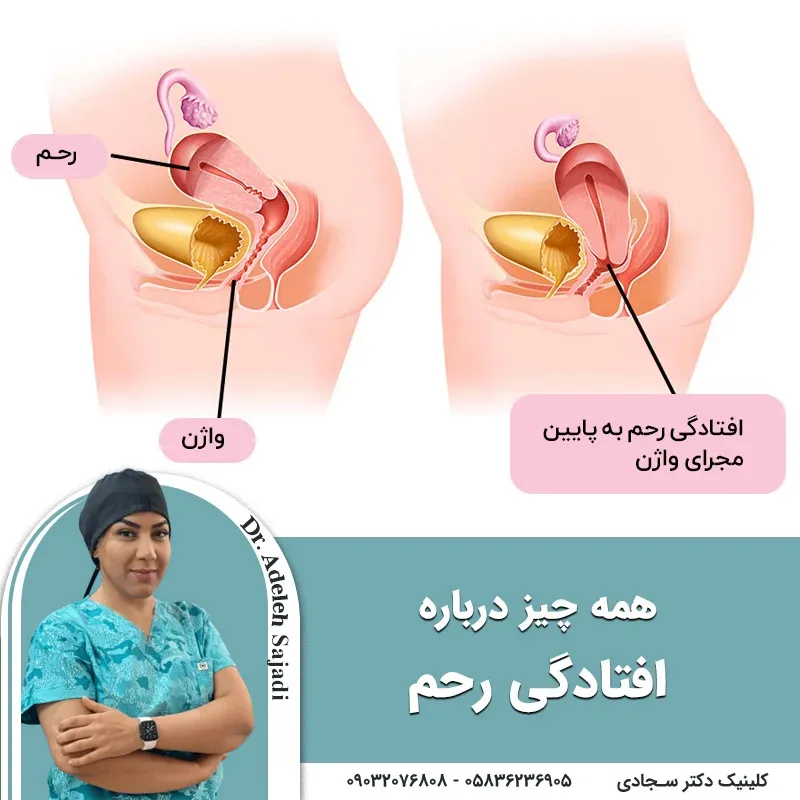 همه چیز درباره افتادگی رحم