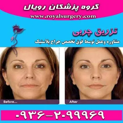 فیلم تزریق چربی