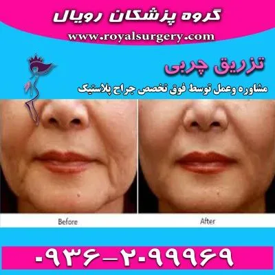 ماندگاری تزریق چربی