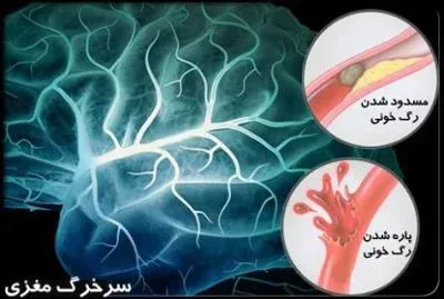 علایم سکته مغزی