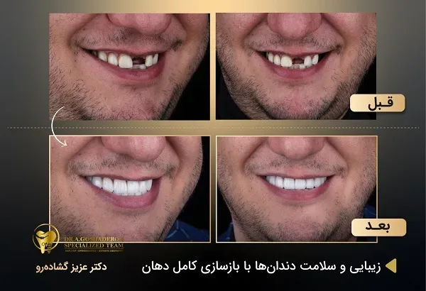 بهترین متخصص ایمپلنت در تهران _ دکتر عزیز گشاده رو