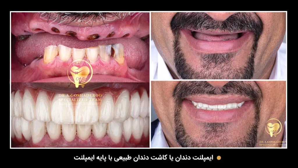 ایمپلنت یک دقیقه‌ای؛ واقعیت یا تبلیغ فریبنده !!