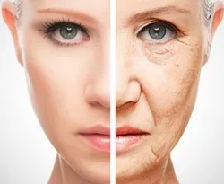 رفع چین و چروک پوست با بوتاکس گیاهی