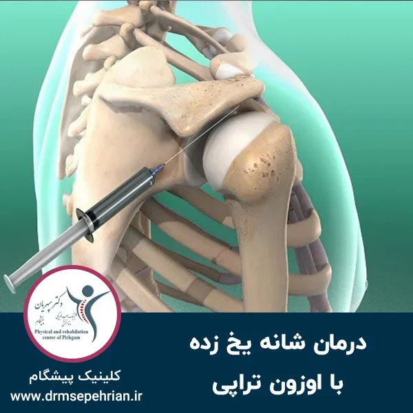 درمان شانه یخ زده با اوزون تراپی
