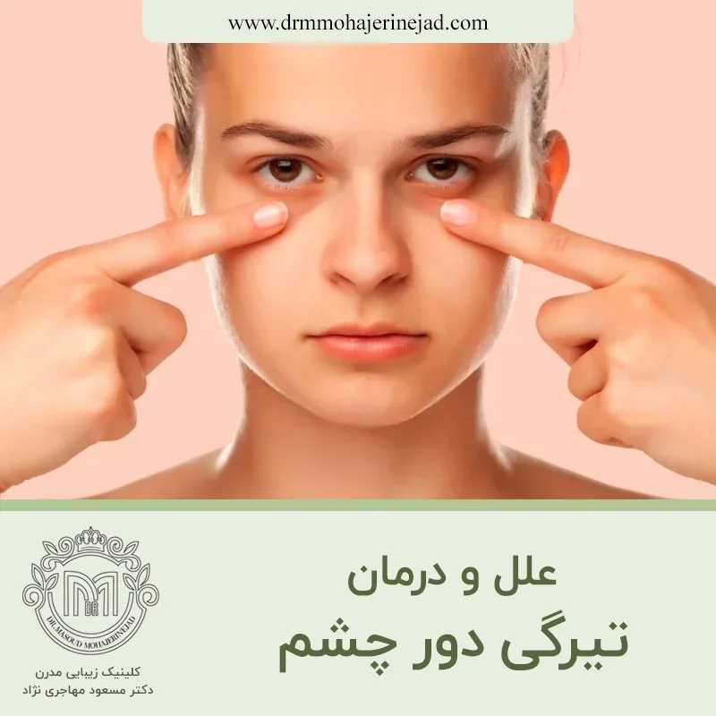 علل و درمان تیرگی دور چشم