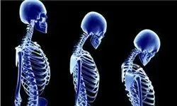 برای بهبود استخوان شکسته چه بخوریم؟