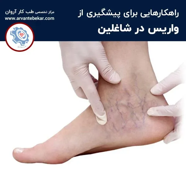پیشگیری از واریس در شاغلین