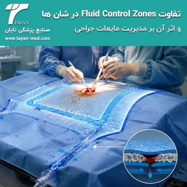 تفاوت Fluid Control Zones در شان ها و اثر آن بر مدیریت مایعات جراحی