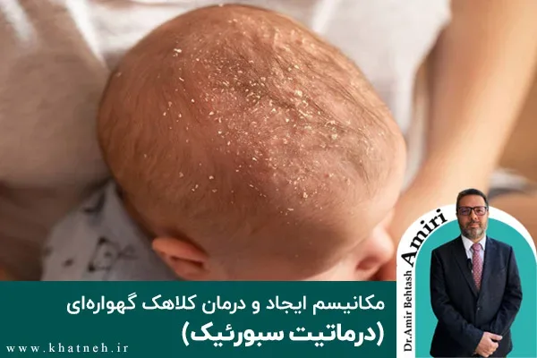 مکانیسم ایجاد و درمان کلاهک گهواره‌ای (درماتیت سبورئیک)